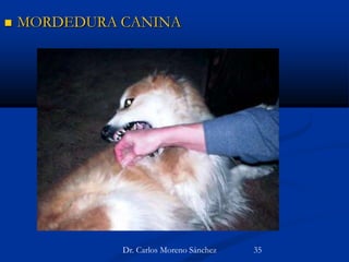  MORDEDURA CANINA
Dr. Carlos Moreno Sánchez 35
 