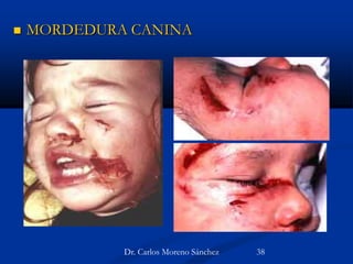  MORDEDURA CANINA
Dr. Carlos Moreno Sánchez 38
 