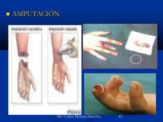  AMPUTACIÓN
Dr. Carlos Moreno Sánchez 42
 
