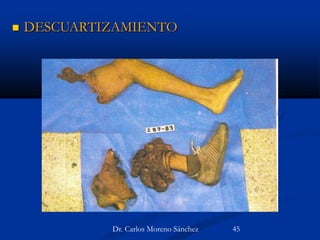  DESCUARTIZAMIENTO
Dr. Carlos Moreno Sánchez 45
 