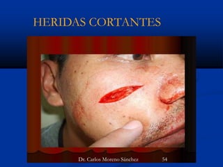 HERIDAS CORTANTES
Dr. Carlos Moreno Sánchez 54
 