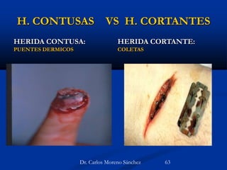 H. CONTUSAS VS H. CORTANTES
HERIDA CONTUSA:
PUENTES DERMICOS
HERIDA CORTANTE:
COLETAS
Dr. Carlos Moreno Sánchez 63
 