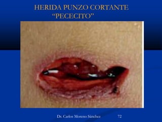 HERIDA PUNZO CORTANTE
“PECECITO”
Dr. Carlos Moreno Sánchez 72
 