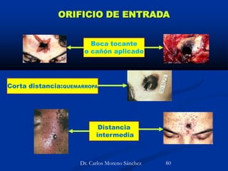ORIFICIO DE ENTRADA
Boca tocante
o cañón aplicado
Corta distancia:QUEMARROPA
Distancia
intermedia
Dr. Carlos Moreno Sánchez 80
 