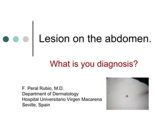 Lesion on the abdomen. What is you diagnosis? F. Peral Rubio, M.D. Department of Dermatology Hospital Universitario Virgen Macarena Seville, Spain 