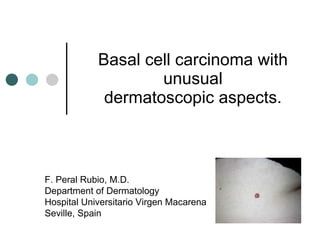 Basal cell carcinoma with unusual dermatoscopic aspects. F. Peral Rubio, M.D. Department of Dermatology Hospital Universitario Virgen Macarena Seville, Spain 