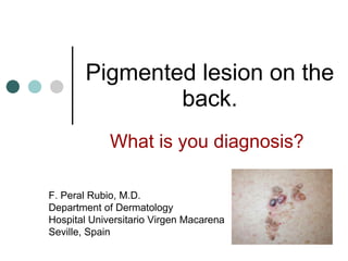 Pigmented lesion on the back. What is you diagnosis? F. Peral Rubio, M.D. Department of Dermatology Hospital Universitario Virgen Macarena Seville, Spain 