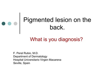 Pigmented lesion on the
               back.
             What is you diagnosis?

F. Peral Rubio, M.D.
Department of Dermatology
Hospital Universitario Virgen Macarena
Seville, Spain
 