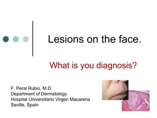 Lesions on the face.

                  What is you diagnosis?

F. Peral Rubio, M.D.
Department of Dermatology
Hospital Universitario Virgen Macarena
Seville, Spain
 