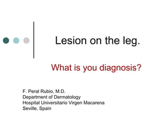 Lesion on the leg.

             What is you diagnosis?

F. Peral Rubio, M.D.
Department of Dermatology
Hospital Universitario Virgen Macarena
Seville, Spain
 