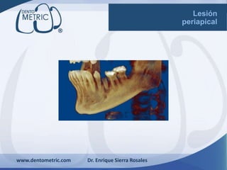 Lesión
periapical
www.dentometric.com Dr. Enrique Sierra Rosales
 