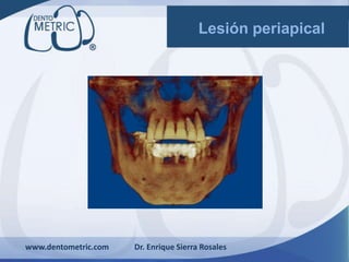 www.dentometric.com Dr. Enrique Sierra Rosales
Lesión periapical
 