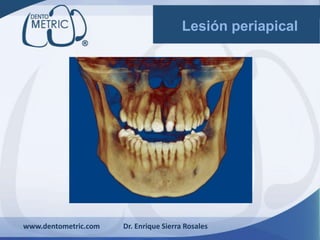 www.dentometric.com Dr. Enrique Sierra Rosales
Lesión periapical
 