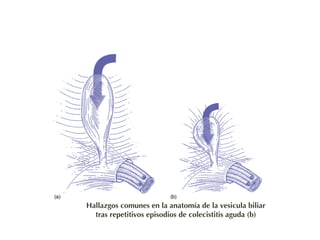 Hallazgos comunes en la anatomía de la vesicula biliar 
tras repetitivos episodios de colecistitis aguda (b) 
 