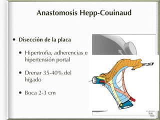 Anastomosis Hepp-Couinaud 
• Disección de la placa 
• Hipertrofia, adherencias e 
hipertensión portal 
• Drenar 35-40% del 
hígado 
• Boca 2-3 cm 
66 
 