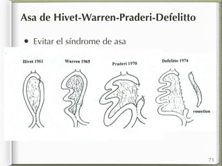 Asa de Hivet-Warren-Praderi-Defelitto 
• Evitar el síndrome de asa 
71 
 