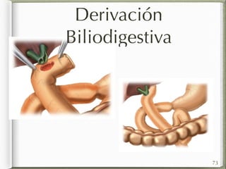 Derivación 
Biliodigestiva 
73 
 