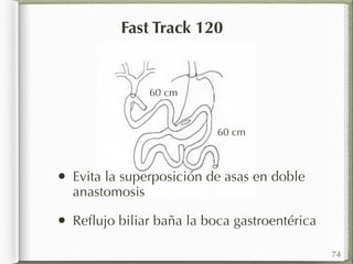 Fast Track 120 
60 cm 
60 cm 
• Evita la superposición de asas en doble 
anastomosis 
• Reflujo biliar baña la boca gastroentérica 
74 
 