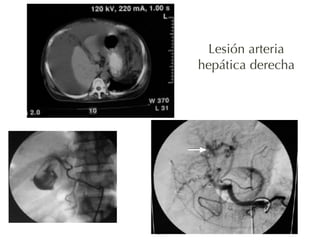 81 
Lesión arteria 
hepática derecha 
 