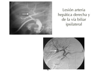82 
Lesión arteria 
hepática derecha y 
de la vía biliar 
ipsilateral 
 