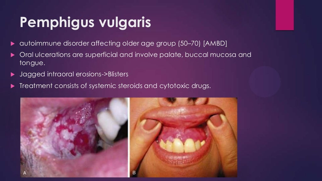 Lesions of oral cavity