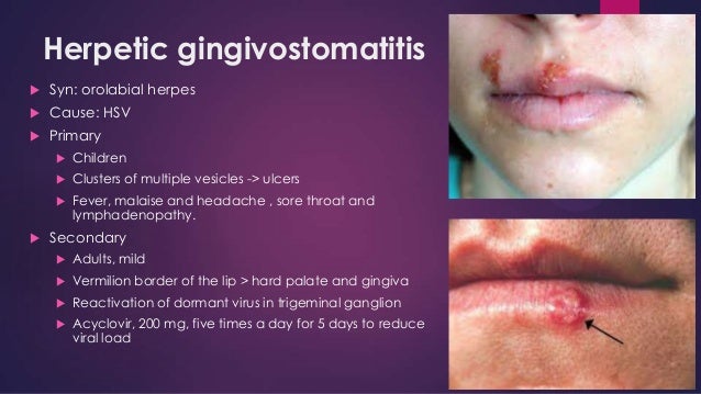 Mouth Herpes – Pictures, Symptoms and Treatment