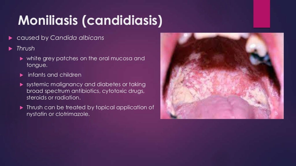 Lesions of oral cavity