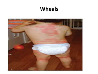 Wheals Examples Lesions and abrasions in skin | PDF