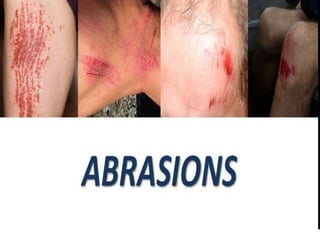 lesions and abrasions.pptx