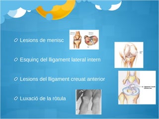 Lesions de menisc  Esquinç del lligament lateral intern  Lesions del lligament creuat anterior  Luxació de la ròtula  