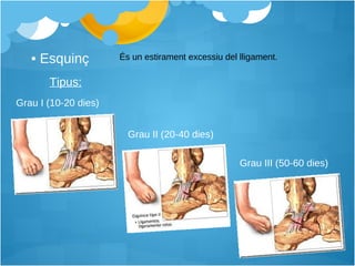 Esquinç És un estirament excessiu del lligament. Grau I (10-20 dies) Grau II (20-40 dies) Grau III (50-60 dies) Tipus: 