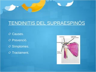 TENDINITIS DEL SUPRAESPINÓS Causes. Prevenció. Símptomes. Tractament. 