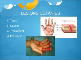 LESIONS CUTÀNIES Tipus Causes Tractament Prevenció 