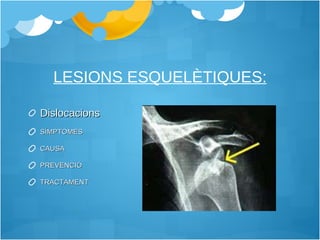 LESIONS ESQUELÈTIQUES: Dislocacions SÍMPTOMES CAUSA PREVENCIÓ TRACTAMENT 