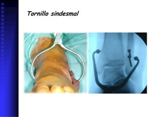 Tornillo sindesmal
 