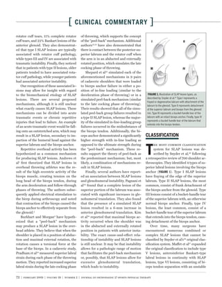 [   CLINICAL COMMENTARY                                    ]
rotator cuff tears, 11% complete rotator       of throwing, which supports the concept
cuff tears, and 22% Bankart lesions of the     of the “peel-back” mechanism. Additional
anterior glenoid. They also demonstrat-        authors12,31 have also demonstrated that
ed that type I SLAP lesions are typically      there is contact between the posterior-su-
associated with rotator cuff pathology,        perior labrum and the rotator cuff when
while types III and IV are associated with     the arm is in an abducted and externally
traumatic instability. Finally, they noticed   rotated position, which simulates the late
that in patients with type II lesions, older   cocking phase of throwing.
patients tended to have associated rota-           Shepard et al27 simulated each of the
tor cuff pathology, while younger patients     aforementioned mechanisms in 9 pairs
had associated anterior instability.           of cadaveric shoulders that were loaded
    Our recognition of these associated le-    to biceps anchor failure in either a po-
sions may allow for insight with regard        sition of in-line loading (similar to the
to the biomechanical etiology of SLAP          deceleration phase of throwing) or in a                      Illustration of SLAP lesion types, as
                                                                                               described by Snyder et al.22 Type I represents a
lesions. There are several proposed            simulated peel-back mechanism (similar
                                                                                               frayed or degenerative labrum with attachment of the
mechanisms, although it is still unclear       to the late cocking phase of throwing).         labrum to the glenoid. Type II represents detachment
what exactly causes SLAP lesions. These        Their results showed that all of the simu-      of the superior labrum and biceps from the glenoid
mechanisms can be divided into acute           lated peel-back group failures resulted in      rim. Type III represents a bucket-handle tear of the
traumatic events or chronic repetitive         a type II SLAP lesion, whereas the major-       labrum with an intact biceps anchor. Finally, type IV
                                                                                               represents a bucket handle tear of the labrum that
injuries that lead to failure. An example      ity of the simulated in-line-loading group
                                                                                               extends into the biceps tendon.
of an acute traumatic event would be fall-     failures occurred in the midsubstance of
ing onto an outstretched arm, which may        the biceps tendon. Additionally, the bi-
result in a SLAP lesion, secondary to im-      ceps anchor demonstrated a signiﬁcantly
paction of the humeral head against the        higher strength with in-line loading as
superior labrum and the biceps anchor.         opposed to the ultimate strength during

                                                                                              T
                                                                                                    he most common classiﬁcation
    Repetitive overhead activity has been      the “peel-back” mechanism. These re-                 system for SLAP lesions was de-
hypothesized as a common mechanism             sults support the theory of peel-back as             scribed by Snyder et al,29 following
for producing SLAP lesions. Andrews et         the predominant mechanism; but, most           a retrospective review of 700 shoulder ar-
al1 ﬁrst theorized that SLAP lesions in        likely, a combination of mechanisms re-        throscopies. They identiﬁed 4 types of su-
overhead throwing athletes was the re-         sult in SLAP lesions.                          perior labral lesions involving the biceps
sult of the high eccentric activity of the         Finally, several authors have report-      anchor (          ). Type I SLAP lesions
biceps muscle, creating tension on the         ed an association between SLAP lesions         have fraying of the edge of the superior
long head of the biceps tendon, during         and glenohumeral instability. Pagnani et       labrum. Type II SLAP lesions, the most
the arm deceleration and follow-through        al24 found that a complete lesion of the       common, consist of frank detachment of
phases of throwing. The authors subse-         superior portion of the labrum was asso-       the biceps anchor from the glenoid. Type
quently applied electrical stimulation to      ciated with signiﬁcant increases in gle-       III lesions consist of a bucket-handle tear
the bicep during arthroscopy and noted         nohumeral translation. They also found         of the superior labrum with, an otherwise
that contraction of the biceps caused the      that the presence of a simulated SLAP          normal biceps anchor. Finally, type IV
biceps anchor to effectively separate from     lesion resulted in a 6-mm increase in          lesions, the least common, consist of a
the glenoid.2                                  anterior glenohumeral translation. Kim         bucket-handle tear of the superior labrum
    Burkhart and Morgan4 have hypoth-          et al14 reported that maximal biceps ac-       that extends into the biceps tendon, caus-
esized that a “peel-back” mechanism            tivity occurred when the shoulder was          ing detachment of the biceps anchor.
may produce a SLAP lesion in the over-         in the abducted and externally rotated             Over time, many surgeons have
head athlete. They believe that when the       position in patients with anterior insta-      encountered numerous combined or
shoulder is placed in a position of abduc-     bility. The exact cause-and-effect rela-       complex SLAP lesions that cannot be
tion and maximal external rotation, the        tionship of instability and SLAP lesions       classiﬁed by Snyder et al’s29 original clas-
rotation causes a torsional force at the       is still unclear. It may be that instability   siﬁcation system. Maffet et al17 expanded
base of the biceps. In a cadaveric study,      allows for a pathologic range of motion        the original classiﬁcation to include type
Pradham et al25 measured superior labral       that facilitates the peel-back mechanism       V lesions, anteroinferior Bankart-type
strain during each phase of the throwing       or, possibly, that SLAP lesions allow for      labral lesions in continuity with SLAP
motion. They reported increased superior       excessive glenohumeral translation,            lesions, type VI lesions, consisting of bi-
labral strain during the late cocking phase    which leads to instability.                    ceps tendon separation with an unstable


72 | february 2009 | volume 39 | number 2 | journal of orthopaedic & sports physical therapy
 