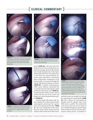 [        CLINICAL COMMENTARY                                            ]




             An arthroscopic shaver is used to prepare
the bed of the SLAP lesion (A) and then an 18-gauge                     A hole is drilled into the bed of the SLAP
spinal needle is passed percutaneously through             lesion via the anterior lateral portal (A) and a suture
the superior labrum via the region of the portal of        anchor is then inserted (B).
Neviaser (B).
                                                          portal (            ). After the bed of the
                                                          SLAP lesion has been satisfactorily pre-
                                                          pared, an 18-gauge spinal needle is passed
                                                          via a transdermal puncture in the region
                                                          of the portal of Neviaser into arthroscop-
                                                          ic view above the superior labrum. Ac-
                                                          curate suture placement is ensured by
                                                          direct arthroscopic visualization of the
                                                          spinal needle as it is passed through the                                 The medial limb of the suture anchor is
                                                          superior labrum from superior to inferior                   tied to the inferior limb of the polydioxanone (PDS)
                                                                                                                      suture from the anterosuperior lateral portal (A
                                                          (          ). A number 1 polydioxanone                      and B). The 2 sutures are tied outside the shoulder
                                                          (PDS) suture (Ethicon, Somerville, NJ)                      and the opposite limb of the PDS is pulled (C). This
                                                          is manually advanced through the spinal                     allows the medial limb of the suture anchor to be
                                                          needle into arthroscopic view (           ).                shuttled through the labral tissue. This limb can now
                                                          An arthroscopic retriever is then used to                   be retrieved above the labral lesion and retrieved via
                                                                                                                      anterosuperior lateral portal.
                                                          retrieve the free end of the suture and
                                                          bring it out via the standard anterior por-                and both sutures are brought out through
                                                          tal (          ).                                          the anterosuperior lateral portal (
                                                              A suture anchor (Bio-Suture Tak, Ar-                       ). The 2 sutures are tied outside the
                                                          threx, Naples, FL) is then inserted via the                shoulder and the opposite limb of the
                                                          anterosuperior portal into the superior                    PDS suture is pulled. The medial limb
            A polydioxanone (PDS) suture is then          neck of the glenoid off the face (                         of the suture from the suture anchor is
manually advanced through the spinal needle (A)           12). The more-medial limb of the suture                    then shuttled through the superior labral
and retrieved via the standard anterior interval          from the suture anchor is then retrieved                   tissue and then retrieved into the antero-
portal (B).
                                                          with the inferior limb of the PDS suture,                  superior lateral portal. A standard ar-


76 | february 2009 | volume 39 | number 2 | journal of orthopaedic & sports physical therapy
 