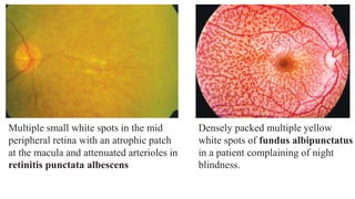 Flecks Rettine Lesions of retina | PPTX