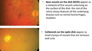 Nvd Optometry Lesions of retina | PPTX