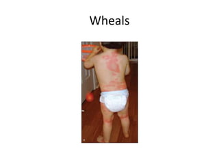 Wheals Examples Lesions of skin | PPTX