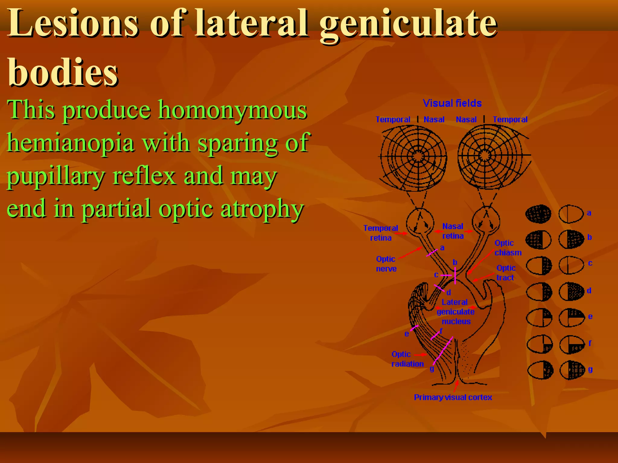 Lesions of the visual pathway | PPT