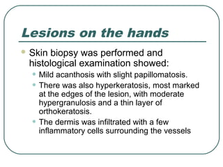 Lesions on the hands
 Skin biopsy was performed and
 histological examination showed:
  • Mild acanthosis with slight papillomatosis.
  • There was also hyperkeratosis, most marked
      at the edges of the lesion, with moderate
      hypergranulosis and a thin layer of
      orthokeratosis.
  •   The dermis was infiltrated with a few
      inflammatory cells surrounding the vessels
 