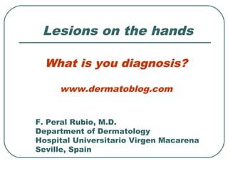 Lesions on the hands

  What is you diagnosis?

     www.dermatoblog.com


F. Peral Rubio, M.D.
Department of Dermatology
Hospital Universitario Virgen Macarena
Seville, Spain
 