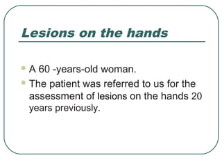 Lesions on the hands

A  60 -years-old woman.
 The patient was referred to us for the
  assessment of lesions on the hands 20
 years previously.
 