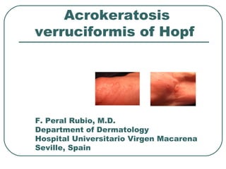 Acrokeratosis
verruciformis of Hopf




F. Peral Rubio, M.D.
Department of Dermatology
Hospital Universitario Virgen Macarena
Seville, Spain
 
