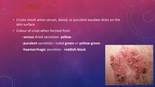 Diffuse Rash Crust Lesion of skin | PPTX