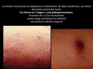 Les lésions maculeuses ou papuleuses se distribuent de façon symétrique, au niveau
des pieds surtout des mains
Ces lésions en « bague » sont pathognomoniques.
arrondies de 1 à 2cm de diamètre
centre rouge cyanotique (ou bulleux)
une bordure saillante rouge vif
 
