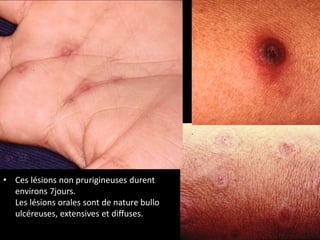 • Ces lésions non prurigineuses durent
environs 7jours.
Les lésions orales sont de nature bullo
ulcéreuses, extensives et diffuses.
 