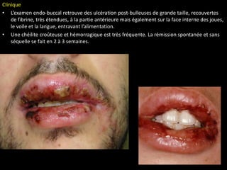 Clinique
• L’examen endo-buccal retrouve des ulcération post-bulleuses de grande taille, recouvertes
de fibrine, très étendues, à la partie antérieure mais également sur la face interne des joues,
le voile et la langue, entravant l’alimentation.
• Une chéilite croûteuse et hémorragique est très fréquente. La rémission spontanée et sans
séquelle se fait en 2 à 3 semaines.
 