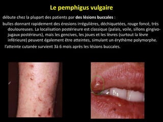 Le pemphigus vulgaire
débute chez la plupart des patients par des lésions buccales :
bulles donnant rapidement des érosions irrégulières, déchiquetées, rouge foncé, très
douloureuses. La localisation postérieure est classique (palais, voile, sillons gingivo-
jugaux postérieurs), mais les gencives, les joues et les lèvres (surtout la lèvre
inférieure) peuvent également être atteintes, simulant un érythème polymorphe.
l’atteinte cutanée survient 3à 6 mois après les lésions buccales.
 